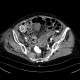 Mesenterial ischemia, gas in portal vein: CT - Computed tomography
